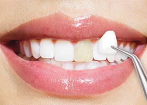 What Can Porcelain Veneers Fix?